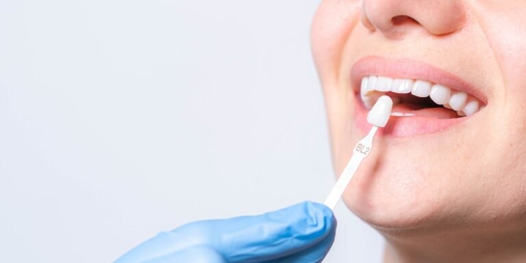 Dents résine capdentaire : comprendre cette solution dentaire moderne, esthétique et accessible